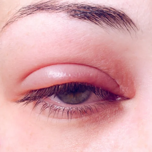 The world’s first bacteriophage-based eye drop