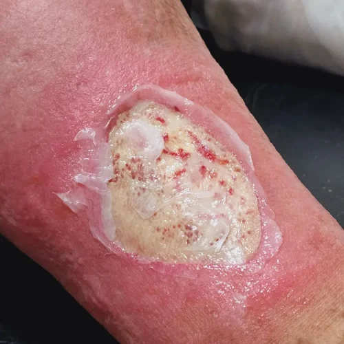 The Potential to Transform the Care of Diabetic Foot Infections